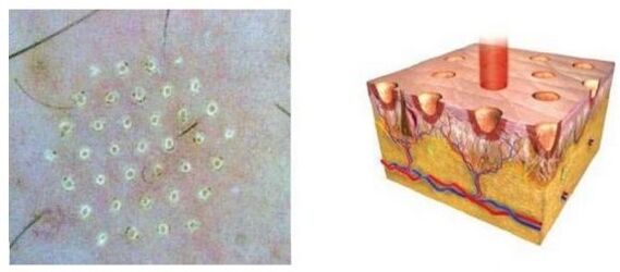 Fraction laser affects the point of the skin