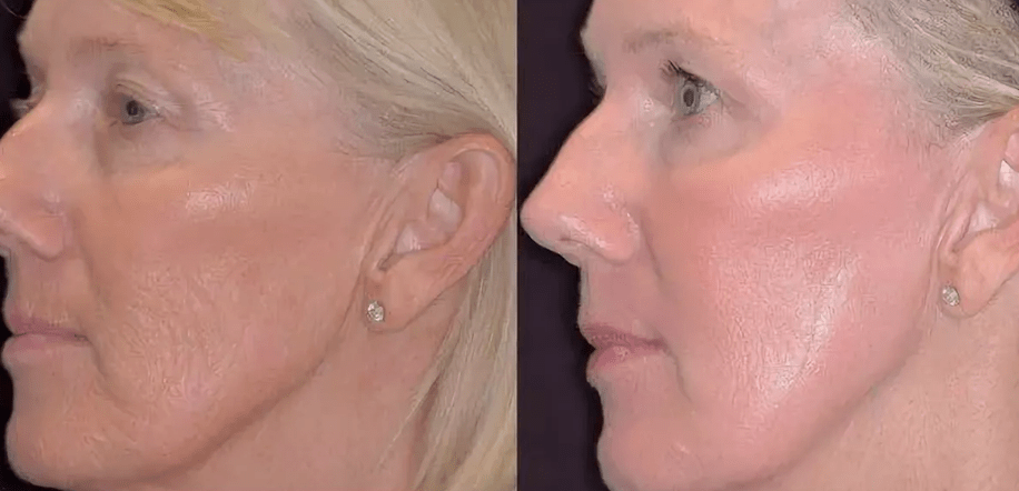 Photothermolysis of laser before and after