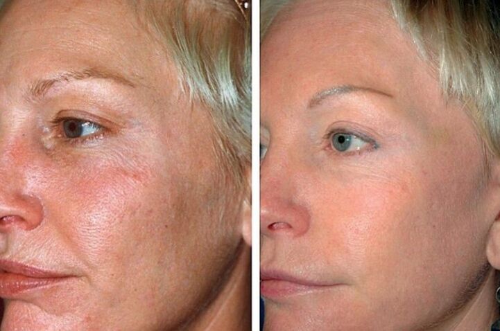 Before and after the renewal process