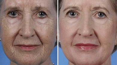 fractional facial skin rejuvenation before and after photos