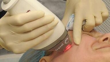 How is fractional skin renewal done