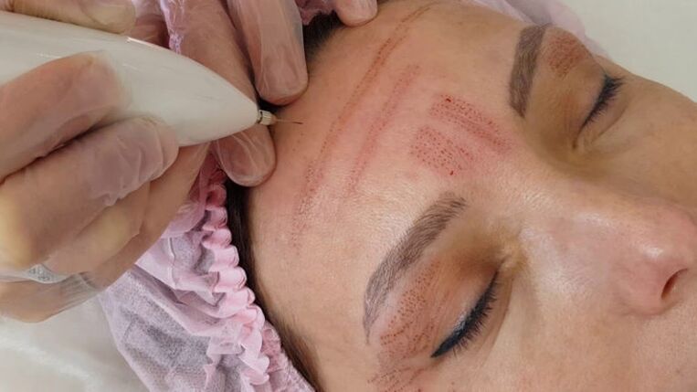 Facial rejuvenation with plasma