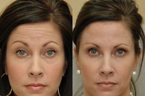 Botulinum toxin injections are suitable for use in any area of ​​the face