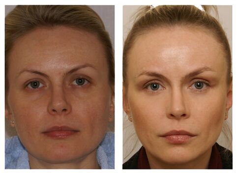 Course of injections with meso cocktails