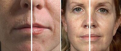 before and after fractional skin renewal